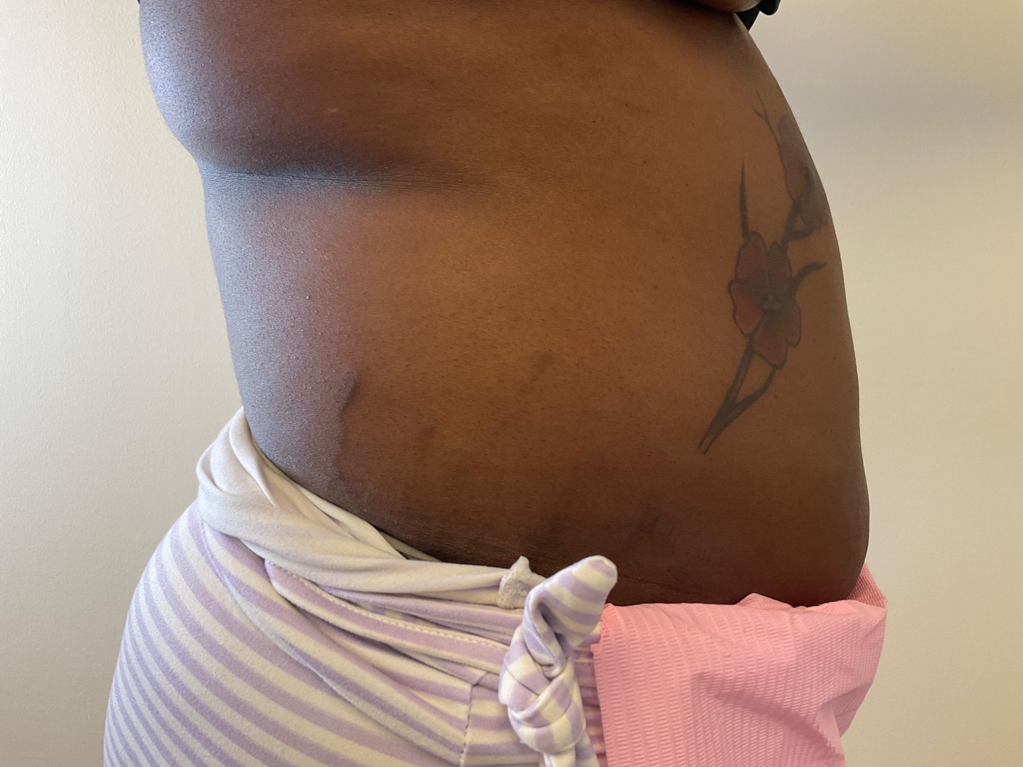 Fat dissolving after – angle