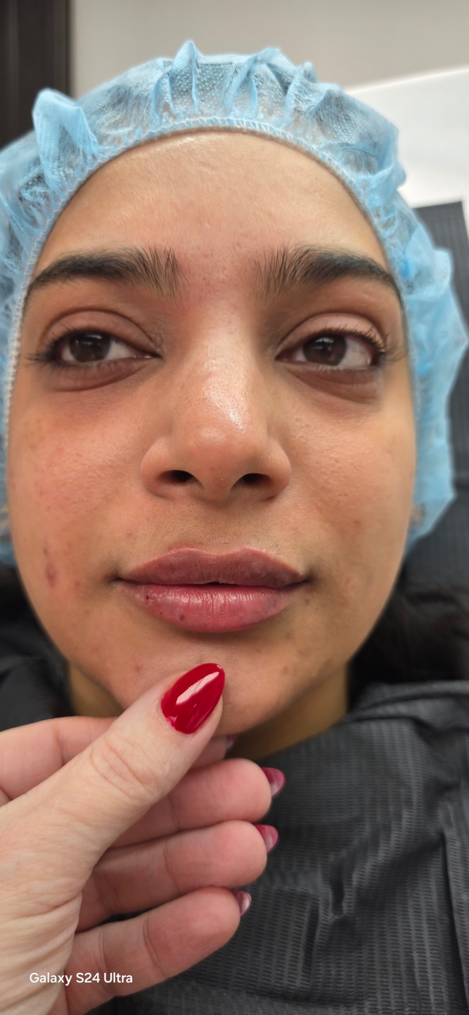 Lips after – Set B